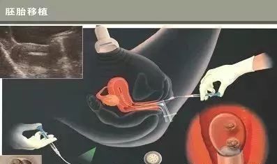 乌克兰试管助孕服务